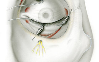 Monitoring of the nerves which control extraocular muscle function is important during many procedures of the cranial base. Electrodes placed around the orbit can record electromyographic responses from the lateral rectus (abducens nerve, 6), the inferior rectus (oculomotor nerve, 3), and superior oblique (trochlear nerve, 4). Care must be taken to place these electrodes with their tips oriented away for the globe and towards the orbital wall.
