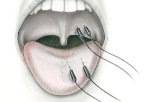 During surgery involving the lower cranial nerves electrode pairs are placed in the tongue and soft palate. (PP, pharyngeal plexus; 12, hypoglossal nerve.)