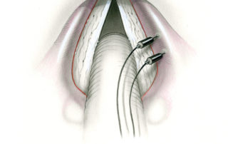 There are several methods of monitoring the vagus nerve during cranial base surgery. An electrode pair placed endoscopically into the larynx is capable of recording a robust electromyographic response. To avoid transient alteration of voice, the electrodes can be inserted supraglottically into the false vocal cords. Alternatively, an endotracheal tube is available commercially which allows recording surface electromyography off of the endolaryngeal surface. (10, vagus nerve.)