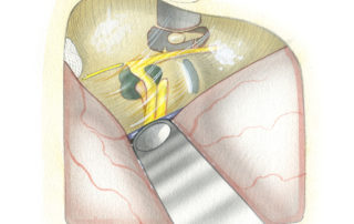 In this transparent view of the petrous contents as seen from above the key landmarks relevent to the middle fossa approach to the IAC can be visualized. The external auditory canal (EAC), middle ear (ME), cochlea (Co), and superior semicircular canal (SSCC) normally lie beneath bone but are made visible as an aid to orientation. (GG, geniculate ganglion; GSPN, greater superficial petrosal nerve; 7, facial nerve; SVN, superior vestibular nerve; SPS, superior petrosal sinus; MMA, middle meningeal artery.)