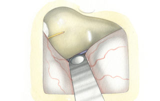 Following completion of dural elevation and engagement of the retractor blade upon the crest of the petrous pyramid, the temporal floor is inspected for any localizing clues as to the orientation of the internal auditory canal. Most helpful are the arcuate eminence overlying the superior semicircular canal and greater superficial petrosal nerve (GSPN). The arcuate eminence (AE) varies considerably; it may be a prominent feature or entirely inapparent. Note wad of packing situated anteriorly in the customary location for venous oozing.