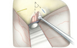 Fisch method. Another method for locating the internal auditory canal in the middle fossa approach commences by “blue lining” the superior semicircular canal by gently drilling along the arcuate eminence. The superior canal has fairly constant angular relationship with the internal auditory canal (approximately 60 degrees).