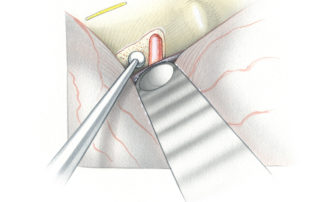 Among the several methods available for localizing the internal auditory canal in the middle fossa floor, I prefer first identifying the porus acousticus. A deep trough is first drilled into the apical petrous bone well anterior to the anticipated location of the canal. Then using the side of a diamond burr, the anterior marigin of the canal’s dura and the porus acousticus are delineated.