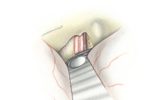 Once the internal auditory canal has been localized, bone removal proceeds from medial to lateral to expose the full length of the canal to the fundus. Care must be taken laterally to remain directly on top of the canal, as excavating adjacent bone risk injury to the inner ear. The margin for error is particularly slim anteriorly, where the cochlea is intimately related to the lateral third of the canal.