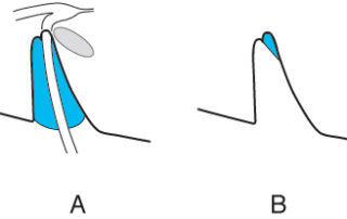 The entry of the facial nerve into its labyrinthine portion inhibits direct visualization of the anterior portion of the fundus. (A) An intracanalicular acoustic neuroma. (B) The portion obscured in the fundus by the overlying facial nerve. (From Driscoll CD, Jackler RK, Pitts LH, Banthia BS. Is the entire internal auditory canal visible during the middle fossa approach for acoustic neuroma? Am J Otol 2000; 21: 382-388, with permission.)