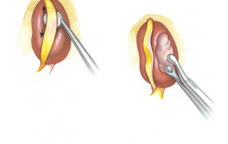 (A) While removing the tumor from beneath the FN, the tumor-nerve interface must first be dissected. (B) The tumor is then debulked to afford addition room for manipulation of the tumor-nerve complex.