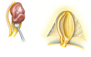(E) Once the tumor has been liberated from the facial nerve, the remaining capsule is dissected from the auditory portion of the eighth nerve. (F) The facial and cochlear nerves remain after tumor removal.