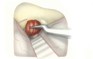 The cavity created during internal auditory canal exposure is filled with a free tissue graft. We formerly used temporalis muscle, but currently employ a small piece of abdominal fat (harvested through a less than 1-inch incision). When the roof of the tympanum is widely opened, it should be repaired to prohibit the middle fossa dura from herniating onto the ossicle heads and inducing a conductive hearing loss. To accomplish this, a sheet of bone is laid over the epitympanic defect. This may be harvested from the thin lower edge of the craniotomy bone flap. Alternatively, a reciprocating saw and be used to split the thicker upper portion of the flap.