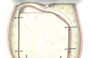 The bone flap is then replaced and wired into position of fixed with miniplates. Note that rather then place the flap centrally surrounded by a equal gap, to facilitate bony fusion it should be coapted against two sides. The lower most margin of the craniotomy (which was earlier removed with rongeur or drill) can be safely left open. This region adjacent to the temporal floor is well protected by the temporalis muscle and zygomatic arch.