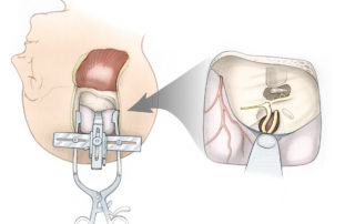Schematic visualization of an intracanalicular acoustic neuroma via the middle fossa approach. The patient is supine with the head rotated to one side. Use of a head holder (e.g., Mayfield) is optional. It is not used by most surgeons. A specialized middle fossa retractor is employed to support the subtemporal dura.