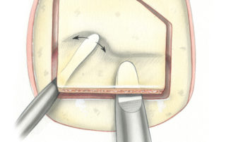 After gently prying up the flap with a spud, the dura may then be elevated from the bone flap. Prior to commencing this maneuver it is important that the peripheral bony trough be well developed.