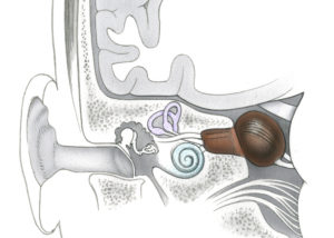Although classically described as an approach to the internal auditory canal, the middle fossa approach may be extended to expose tumor extending into the cerebellopontine angle as depicted here.