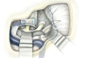 Completed exposure in the combined retrolabyrinthine – middle fossa approach. The relatively narrow exposure provided prior to tentorial division is now substantially enhanced. Access is provided to the lateral aspect of the pons and mid-brain. Sectioning of the tentorium serves not only to make the two exposures confluent but also to untethers the sigmoid sinus which can then be more readily retracted posteriorly. Although the midportion of the cerebellopontine angle is somewhat obscured by the presence of the labyrinth, this can be partially compensated for by the additional visualization obtained from above under the temporal lobe. This technique usually requires that a minimum of three retractors be available. Use of a Mayfield head holder with Leyla arms based upon multiple C-clamps is one technical option. Typically, one retractor retrodisplaces the sigmoid sinus and cerebellum while two others support the temporal lobe. It is important that the temporal lobe be elevated gently and be supported by relatively broad malleable retractors. Injury to vein of Labbé (VL), the predominant drainage to the inferior aspect of the temporal lobe, risks speech and memory disturbances. The degree of retraction is often quite subtle, but depends greatly upon the geometry of the tumor. One factor that reduces the need for temporal lobe retraction is the ability to work through the cavity created in the petrous bone and gaze upward beneath the temporal lobe. (A different dural incision is depicted here than shown in Figure 6-4).