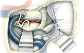 The transcochlear-middle fossa approach provides excellent exposure of the lateral and ventral surfaces of the pons and the lateral surface of the midbrain. As discussed earlier, the transcochlear approach necessitates posterior re-routing of the facial nerve – a maneuver which results in facial paralysis which often recovers only partially and with synkinesis. As a general rule, this technique is employed when the tumor side ear is deaf and the facial nerve is paralyzed pre-operatively. It is also an option when the tumor extensively penetrates the skull base in the region of the apical petrous bone or clivus.