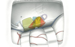 Exposure of the anterior face of the petrous pyramid illustrating the bone removed during the classical middle fossa approach to the internal auditory canal (yellow), the extended middle fossa approach to the cerebellopontine angle (orange), and the middle fossa-trans-petrous apex approach to the anterosuperior cerebellopontine angle (green). In the latter approach, a limited posterior fossa exposure is obtained by opening the interval between the lateral aspect of Meckel’s cave and the medial wall of the internal auditory canal.