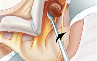 The trigeminal nerve is often splayed by the tumor. In this illustration, it is depicted in a favorable inferior location on the surface of the tumor. Preservation of the trigeminal nerve fibers can be more difficult when the nerve is infiltrated with tumor or has a posterior presentation overlying the tumor from the surgeon’s perspective. Dissection of the trigeminal nerve may lead to bradycardia or even episodes of asytole. These can be mitigated by focal application of topical lidocaine on a piece of Gelfoam and/or via systemic anticolinergic therapy. The first division of the trigeminal nerve (V1) and trochlear nerve (4) can be seen gathering together as they enter the cavernous sinus (CS).