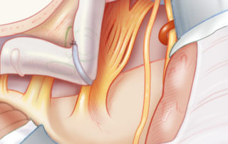 With favorable planes off of the lateral aspect of the cavernous sinus, resection is completed.