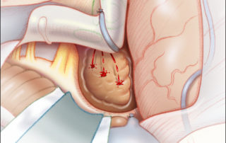 (A) Interruption of the dural base of the meningioma typically trigger brisk arterial bleeding from its feeding vessels.