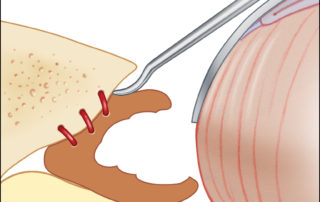 (B) The arterial feeder frequently traverse hyperostotic bone.