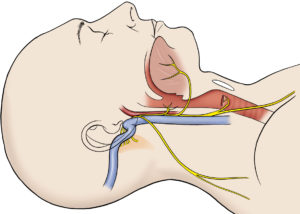 Anatomical overview of the jugular foramen region and its neurovascular relationships. (9, glossopharyngeal nerve; 10, vagus nerve; 11, spinal accessory nerve; 13, hypoglossal nerve.)
