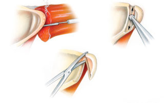 (B) Once the digastric ridge has be identified the mastoid tip can be removed rapidly. A cutting burr can be used to transect the bony attachment of the tip from the lateral surface of the digastric muscle. This is a safe maneuver as the facial nerve always lies medial to the fascia of the superior surface of the muscle. The tip may then be liberated with a stout pair of scissors.