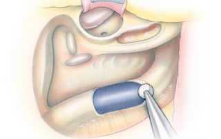 After preliminary skeletonization of the fallopian canal, the remaining bony shell overlying the lower portion of the sigmoid sinus is removed. When the tumor is entirely extracranial. A 1-to 2-cm shelf of bone is left superiorly to facilitate later extraluminal occlusion of the sinus with packing. One to 2 cm of retrosigmoid bone is also removed. When an intracranial component of the tumor exists the sinus is completely decompressed both to facilitate exposure as well as to allow ligation of vessel.