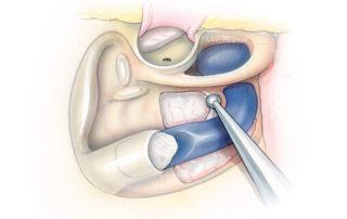 In cases where the tumor is entirely extradural, the author prefers establishing proximal control of the sigmoid sinus through extraluminal packing. Suture ligature requires a blind pass through the posterior fossa, a maneuver which risks tearing veins on the cerebellar surface thereby inducing a subarachnoid hemorrhage. Sinus ligature is utilized, however, during transjugular craniotomy (see “Transjugular Craniotomy”). After firm extralumenal packing with a plug of Surgicel, a piece of Teflon strip (not shown) is placed over it to protect it from displacement while drilling. Surgical has numerous threads which are readily attracted by the rotating shaft of the high-speed drill. Bone overlying the dura anterior to the sigmoid sweep is then removed. Early occlusion of the proximal sigmoid sinus is desirable as this reduces venous in flow into the tumor. By contrast, the jugular vein the neck should not be ligated until just before tumor removal to avoid creating a back-pressure.