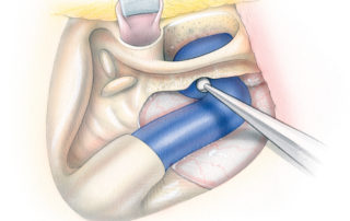 The anterior and posterior exposures must then be interconnected by removing the remaining bone medial to the facial nerve which overlies the jugular bulb. During this maneuver the surgical angle of view is adjusted more posteriorly. When necessary, exposure may be improved by posteriorly displacing the sigmoid sinus with a retractor.