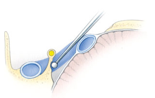 (B) Schematic view from above illustrating removal of the bone deep to the FN in order to connect the anterior and posterior bony openings. (JB, jugular bulb; FN, facial nerve; SS, sigmoid sinus.)