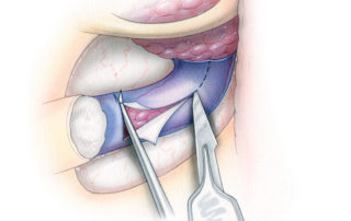 Once the tumor exposure has been completed, tumor removal proceeds rapidly. Preoperative embolization dramatically curtails the tumor’s vascular supply and facilitates more orderly microdissection. After ligating the jugular vein in the neck, the sigmoid sinus is opened sharply. Intralumenal tumor is often encountered at this stage. Occasionally, tumor extends proximally into the transverse sinus.