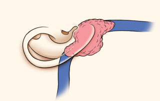 Simplified illustration of a glomus jugulare tumor in relation to the sigmoid sinus and jugular view.