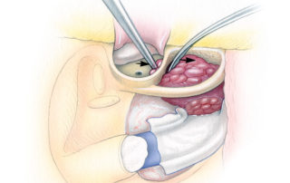 The hypotympanic portion may then be removed either with cup forceps, the laser, or by delivering it into the hypotympanic region where it can be removed with the rest of the tumor. Most often the middle ear component is the last portion of tumor removed.