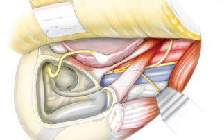 Exposure of the upper neck in the region of the jugular foramen. In this illustration, the canal wall has been taken down and the facial nerve re-routed anteriorly. Neither of these maneuvers is needed in most jugular foramen tumors. When the tumor extensively erodes the carotid wall, adequate exposure requires anterior re-routing of the facial nerve (see chapter “Facial Nerve Rerouting during Skull Base Surgery”) and a canal wall down mastoidectomy. This maneuver provides an unrestricted access to the vascular otobase. Note that the ear canal, tympanic membrane, and lateral two ossicles have been removed and that the external meatus has been sewn shut (see chapter “Ear Canal Closure in Skull Base Surgery”). Again, these are not required in most jugular foramen tumors. It is helpful to be familiar with the course of the ascending pharyngeal artery, the primary blood supply to the jugular foramen. In the presence of a vascular tumor, it is often much larger than it is depicted here. (MC, mandibular condyle; EAM, external auditory meatus; 7, facial nerve; SM, styloid muscles; DM, digastric muscle; SCM, sternocleidomastoid muscle; C1, transverse process of C1; 9, glossopharyngeal nerve; 10, vagus nerve; 11, accessory nerve; 12, hypoglossal nerve; JV, jugular vein; EC, external carotid artery; IC, internal carotid artery; AP, ascending pharyngeal artery.)