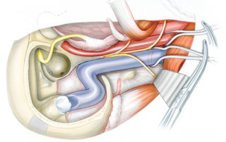 In the initial stage of the neck dissection, loops are placed around both the jugular vein and internal carotid artery to provide vascular control. Care must be excised in protecting the encircling vascular loops from any traction which might injure the carotid artery. After the sternocleidomastoid muscle has been reflected posteriorly, the digastric and styloid muscles are reflected anteriorly. As the dissection is carried superiorly towards the cranial base, the ascending pharyngeal and occipital arteries are ligated along with any other external carotid branches which appear directed towards the tumors. (SM, styloid muscle; DM, diagastric muscle; VA, vertebral artery; C1, lateral process of the first cervical vertebra.)