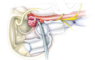 The main bulk of the tumor is removed and the inferior petrosal sinus is controlled with a Surgicel pack. Tumor dissection from the carotid artery proceeds gently along surgical planes which are usually favorable. When the tumor-carotid plane is obscure it is wisest to leave a well coagulated tag on the carotid wall rather than risk vascular injury. There is little role for planned carotid resection in benign lesions of the jugular foramen region, except when the tumor has already completely occluded the vessel. In malignant lesions carotid resection can be considered after an assessment of risk through pre-operative balloon occlusion. A vascular bypass procedure using a saphenous vein graft can also be contemplated.
