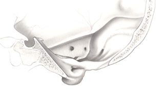 Sagittal perspective of the osseous anatomy of the jugular foramen region. (JT, jugular tubercle; IAC, internal auditory canal; SS, sigmoid sinus; TS, transverse sinus; JF, jugular foramen; HC, hypoglossal canal; OC, occipital condyle.)