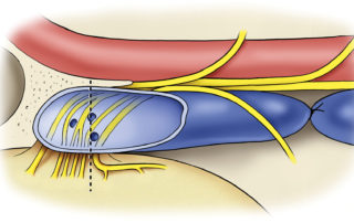 Neurovascular relationships of the jugular foramen in lateral (surgical) (a) and axial (b) views. The dashed line designates the plane of the axial section. The lower cranial nerves (nignth to eleventh) make an approximate 90-degree turn between their brainstem entry zone and foramenal exit into the upper neck. The medical wall of the jugular bulb is perforated by the often multiple opening of the inferior petrosal sinus (IPS). The nerves are aligned on a partially fibrous and partially osseous septum located medical to the jugular bulb.
