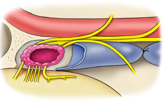After removal of the medical wall of the jugular bulb, tumor can be seen engulfing the multiple thin fibers of the lower cranial nerves.