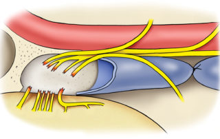 While it is often possible to preserve some or all of the fibers encased in the medial compartment, often they become disrupted during radical tumor removal. In selected cases in which the lower nerves remain functional, incomplete resection as a concession to neural integrity is a reasonable option.