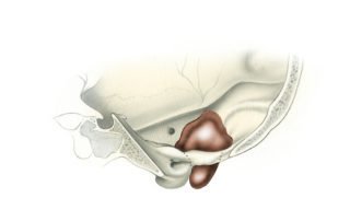 Tumors of the jugular foramen are often dumbbell shaped, possessing both an intra- and extracranial component connected by a segment within the cranial base.