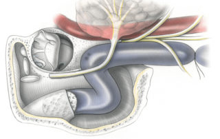 Overview of surgical relationships in the jugular foramen approach. Jugular foramen surgery requires that the sigmoid-jugular complex be controlled both proximally (either by suture ligature or extralumenal packing as depicted here) and distally in the neck. The hypotympanum can be exposed by an inferiorly based tympanomeatal flap. (SCC, semicircular canals; TM, tympanic membrane; CA, carotid artery; SS, sigmoid sinus; JB, jugular bulb; JV, jugular vein; P, parotid gland; FN, facial nerve; 9, glossopharyngeal nerve; 10, vagus nerve; 11, accessory nerve; 12, hypoglossal nerve.)