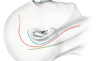 Skin incisions for jugular foramen surgery (red) compared to those for transtemporal (blue) and retrosigmoid (green) approaches. Often the neck scan can be camouflaged in a transversely oriented neck crease. Should a temporalis rotation flap be needed, the incision can be carried forward (dashed line).