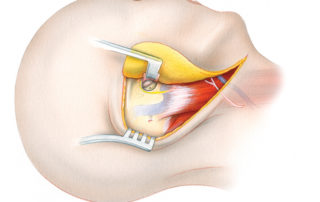 The incision used in approaches to the jugular foramen region curves from the postauricular region into the upper neck. The neck incision is required to gain access to the carotid artery and jugular vein for proximal vascular control as well as for exposure of any extracranial tumor component. The neck incision may be carried further towards the midline should a simultaneous vocal cord augmentation procedure be needed. The flap elevation widely exposes the lateral surface of the temporal bone. Note that a tympanomeatal flap has been developed to provide access to the hypotympanum, a frequent site of involvement by jugular foramen tumors. While connecting the mastoid and neck exposures it is necessary to divide the greater auricular nerve. As a matter of course, this is atraumatically divided and placed aside as a potential nerve graft. Note that the facial nerve lies immediately lateral to the jugular bulb. (GA, greater auricular nerve; EJ, external jugular vein.)