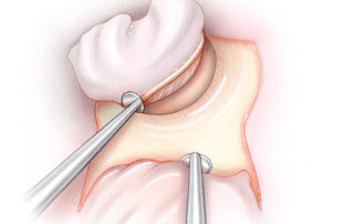 The tympanomeatal flap employed in jugular foramen surgery is reflected superiorly in order to provide wide exposure of the hypotympanic region. The outer portion of the posterior ear canal skin is reflected laterally and then held anterior to the ear canal by retraction.