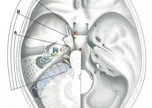 The infratemporal fossa approach, as classified by Fisch, has three primary varieties: type A, for the jugular foramen region, mandibular fossa, and posterior infratemporal fossa; type B, for the apical petrous bone and clivus including the intrapetrous course of the carotid artery; and type C, is an anterior extension used for exposure of the infratemporal fossa, pterygopalatine fossa, parasellar regions, and nasopharynx.