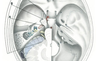 The infratemporal fossa approach, as classified by Fisch, has three primary varieties: type A, for the jugular foramen region, mandibular fossa, and posterior infratemporal fossa; type B, for the apical petrous bone and clivus including the intrapetrous course of the carotid artery; and type C, is an anterior extension used for exposure of the infratemporal fossa, pterygopalatine fossa, parasellar regions, and nasopharynx.