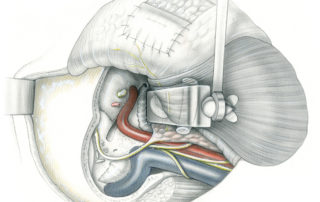 Infratemporal fossa type B approach - postauricular: The horizontal portion of the intrapetrous carotid is exposed to gain access to the petrous apex and clivus. This involves removal of the glenoid fossa and division of the middle meningeal artery and the third division of the trigeminal nerve. The eustachian tube is also removed in the process. Note that the zygomatic arch has been osteotomized and downwardly displaced. The temporalis muscle and its blood supply have been preserved for reconstructive purposed. In contrast to the typa A procedure, the facial nerve is not routinely re-routed. During retraction, its upper division is subject to some stretching, however. The retractor depicted is the infratemporal fossa retractor designed by Fisch (a modified pediatric rib spreader). (ET, eustachian tube; MMA, middle meningeal artery; V3, third division of the trigeminal nerve; MFD, middle fossa dura; MC, mandibular condyle; ZA, zygomatic arch.)
