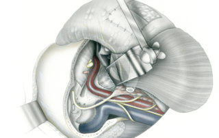 Infratemporal fossa type C approach. This approach extends the type B exposure anteriorly and medially to gain access to the pterygopalatine fossa, parasellar regions, and the nasopharynx. (NPH, nasopharynx; ET, opening of the Eustachian tube.)