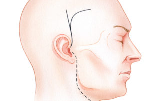 In anteriorly situated infratemporal fossa tumors, there is no need to disturb the otic structures. Preauricular incisions (dashed line) are often employed for infratemporal fossa type B and C approaches. These can be designed to extend superiorly for the exposure required to perform a craniotomy, or inferiorly into the neck.