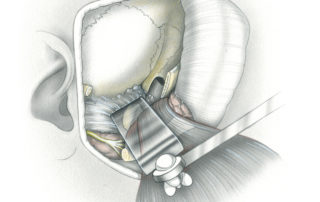 Infratemporal fossa type B approach — preauricular. In the majority cases, type B exposure can be obtained without need for disturbing the middle ear and mastoid. This procedure may include osteotomy and downward displacement of the zygomatic arch if access to the infratemporal compartment below the cranial base is needed.